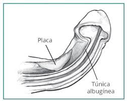 PEYRONIE ARES MEDICAÑ